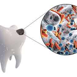 Model showing tooth decay