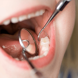 Close up of dentist examining child’s molars