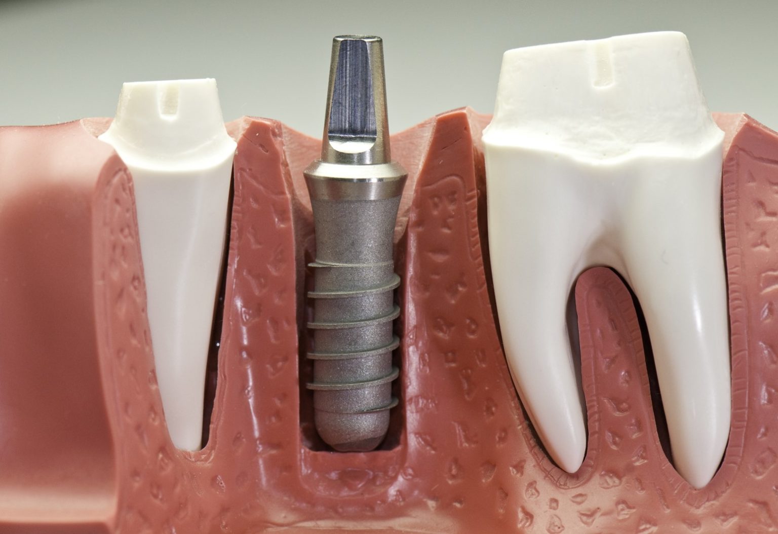 Learn More About The Benefits Of Titanium Dental Implants